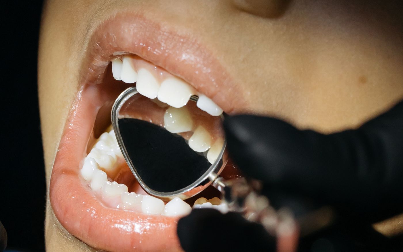 Chalky Teeth and MIH in Children: What Parents Should Notice